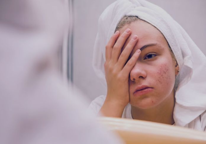 Girl with a towel on her head and looking upset due to her skin disease